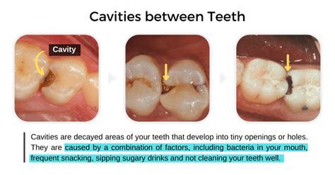 cavity between teeth.